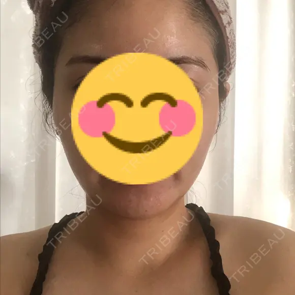 骨削り（エラ） / 骨削り（頬） / 脂肪吸引（顔） View美容整形外科 BEFORE メイン用