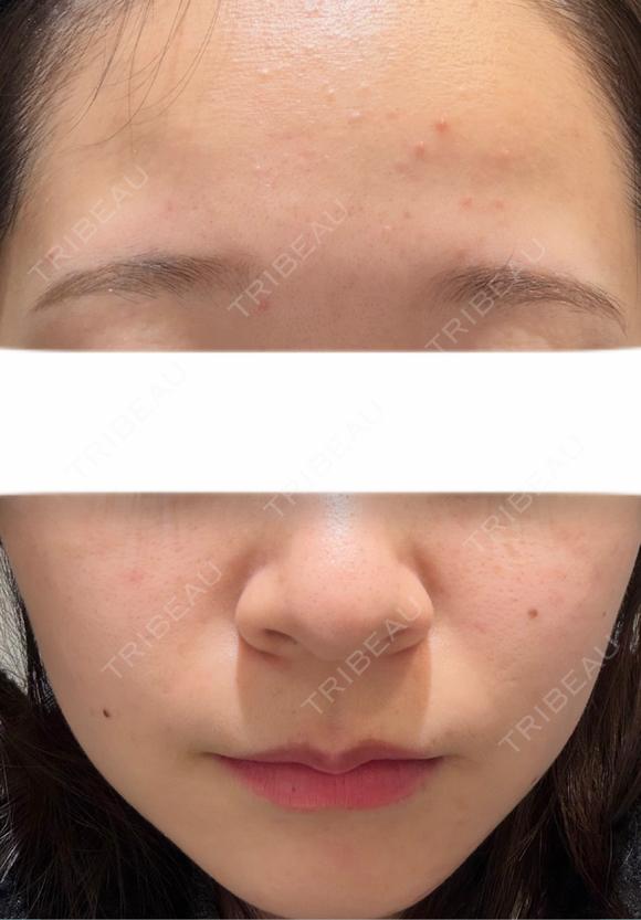 イオン導入 / 光治療（フォトフェイシャルなど） / ルメッカ BITO BEAUTY CLINIC BEFORE メイン用