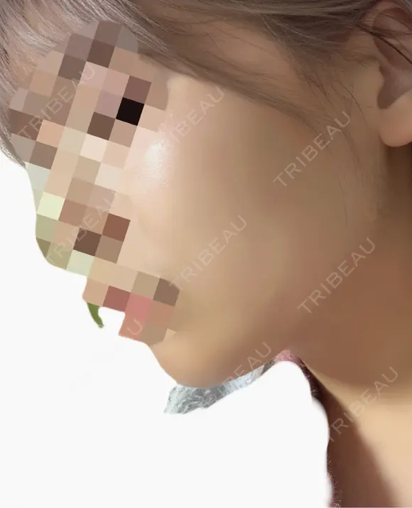 ハイフ（顔） Natural Skin Clinic 自由ヶ丘院 BEFORE メイン用