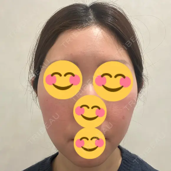 インモード Moon Beauty Clinic BEFORE メイン用