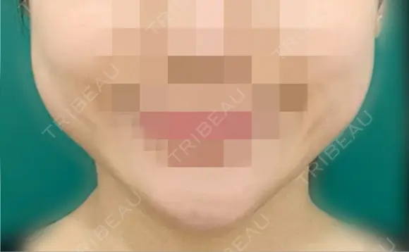 バッカルファット除去 藤・ナチュレ美容クリニック 恵比寿院 BEFORE メイン用