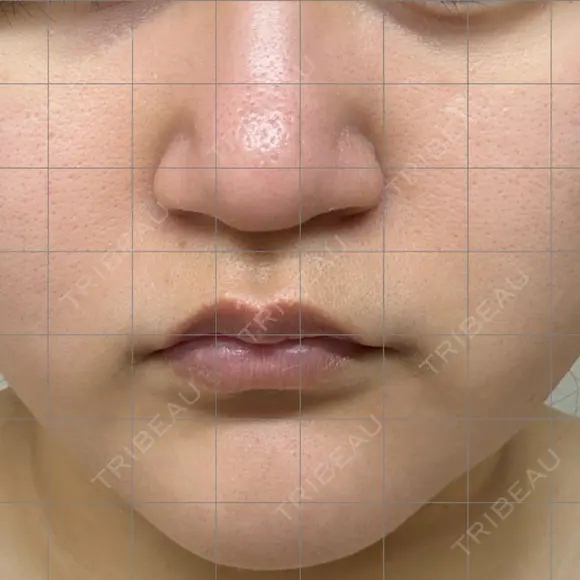 脂肪溶解注射（顔） ミニマムスキンクリニック池袋 BEFORE メイン用