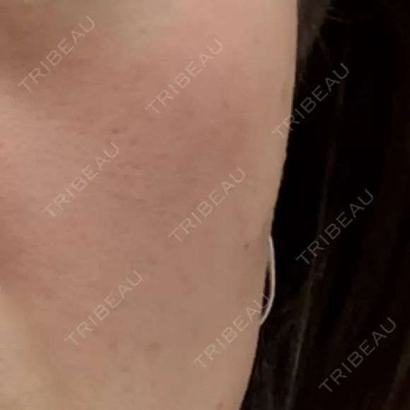 ピーリング（ハリ・ツヤ） ジュエルクリニック 恵比寿院 BEFORE メイン用