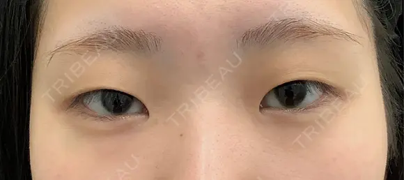 二重埋没 eクリニック 那覇院 BEFORE メイン用