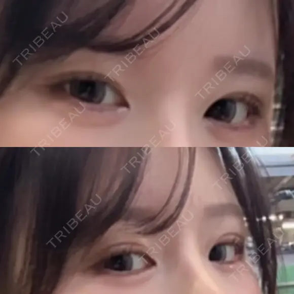 目頭切開 東京シンデレラ美容外科 池袋院 BEFORE メイン用