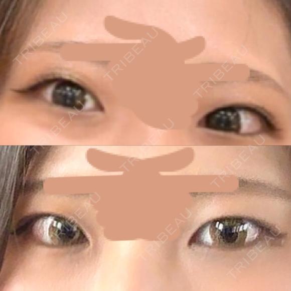 二重埋没 / 目頭切開 BITO BEAUTY CLINIC BEFORE メイン用