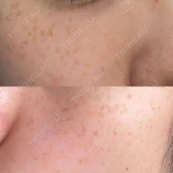 ピーリング（ニキビ・毛穴） / イオン導入 / ルメッカ ルラ美容クリニック 札幌本院 BEFORE メイン用