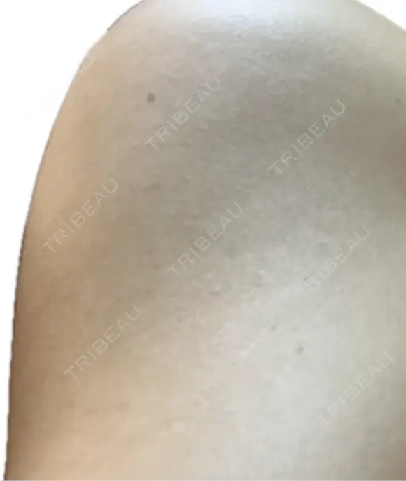 プラセンタ注射 新宿駅三丁目クリニック BEFORE メイン用