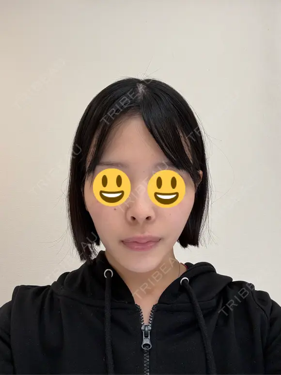 隆鼻術 / 鼻尖形成（切開） / 鼻中隔延長（切開） / 小鼻縮小（切開） / 軟骨移植 / 鼻修正 / 鼻孔縁下降 シンデレラ＆ダヴィンチクリニック BEFORE メイン用