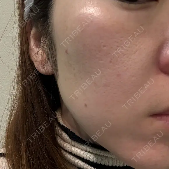 ピーリング（ニキビ・毛穴） / LDM・インテンスウルトラ ライズワン美容皮膚科クリニック BEFORE メイン用