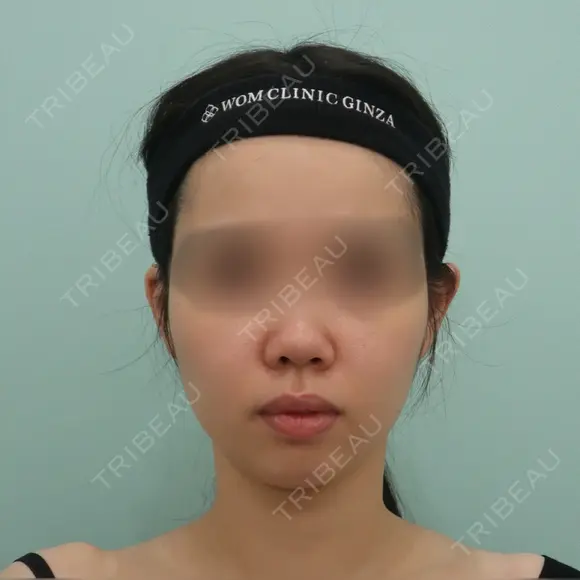 脂肪吸引（顔） / ジョールファット除去 / ボトックス（エラ・小顔） WOM CLINIC GINZA （ワム クリニック ギンザ） BEFORE メイン用