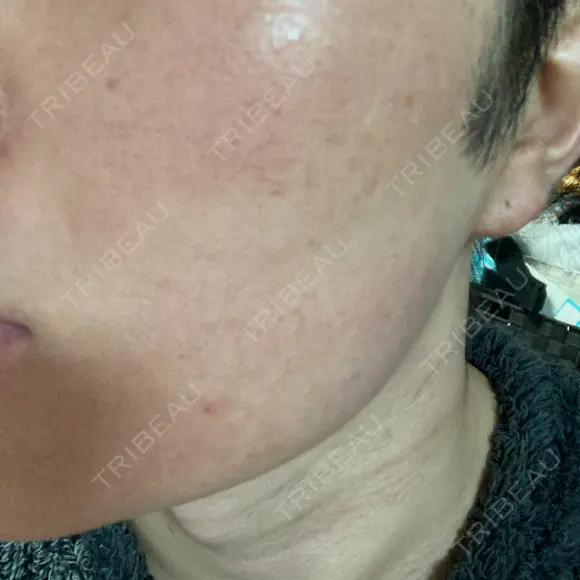 フラクショナルレーザー（毛穴・ニキビ跡） ルラ美容クリニック 大阪本院 BEFORE メイン用