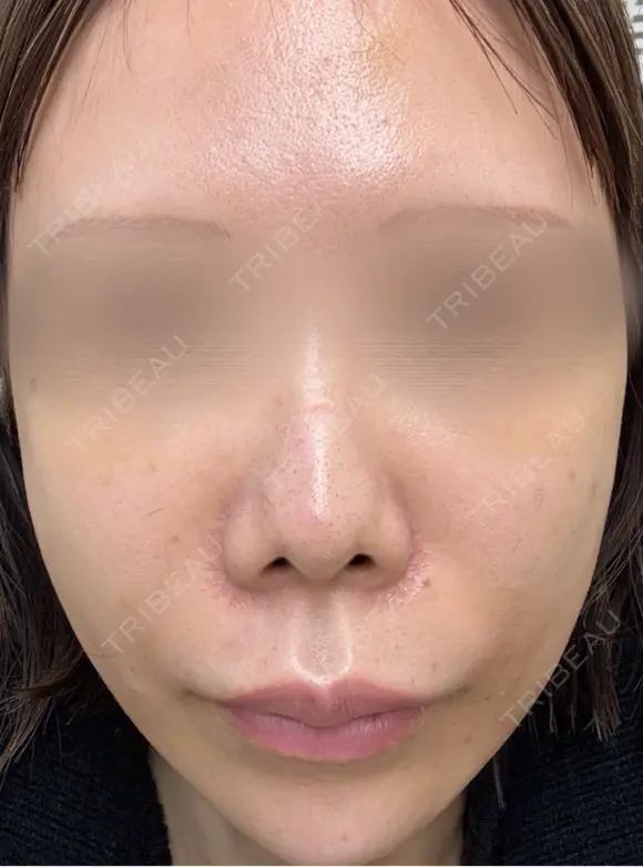 イオン導入 / 光治療（フォトフェイシャルなど） 城本クリニック 岡山院 BEFORE メイン用