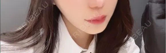 ボトックス（口角） PRO CLINIC プロクリニック 銀座院 BEFORE メイン用