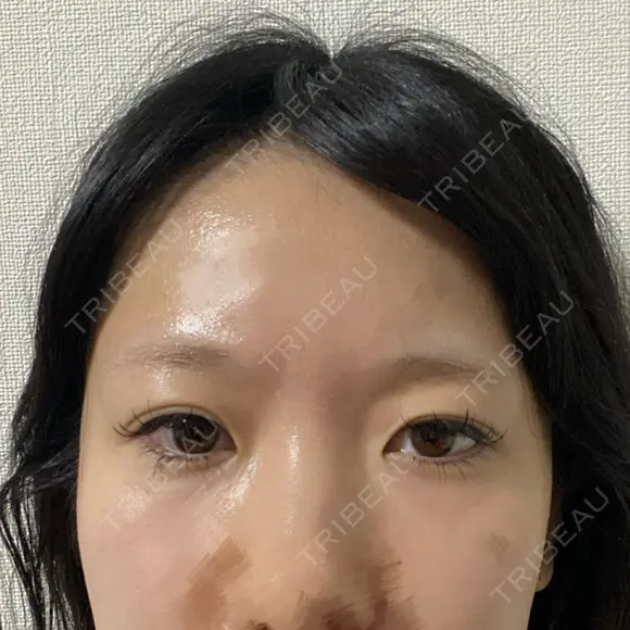 二重埋没 東京シンデレラ美容外科 池袋院 BEFORE メイン用