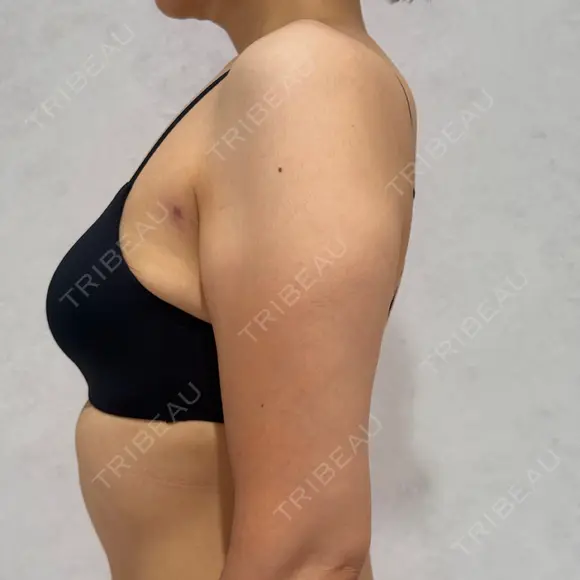 脂肪吸引（脚） / 脂肪吸引（腰） / 脂肪吸引（背中） / 脂肪吸引（肩） アリエル美容クリニック 横浜院 BEFORE メイン用