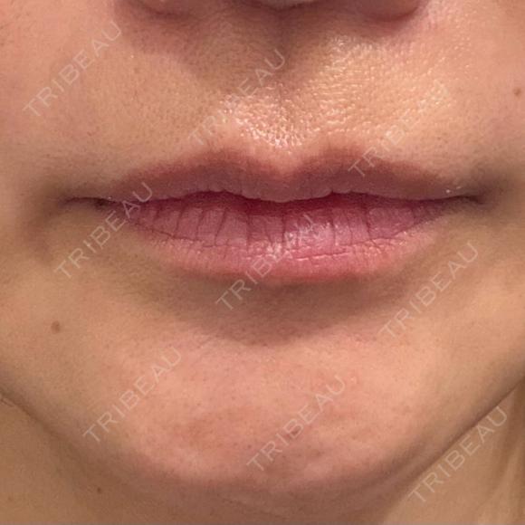 ヒアルロン酸注入（唇） NARU Beauty Clinic 【ナルクリ】 BEFORE メイン用