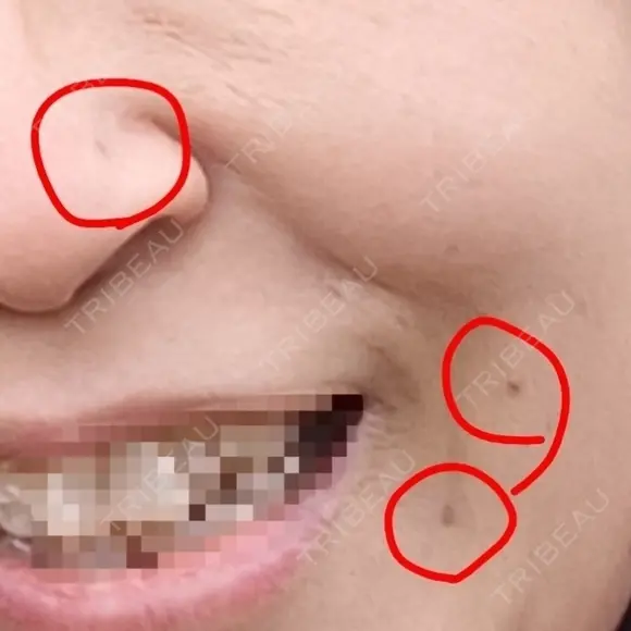 ほくろ・いぼ切除（肌） CLINIC W BEFORE メイン用