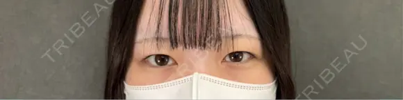 二重埋没 ネビュラクリニック 京都院 BEFORE メイン用