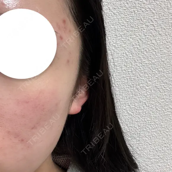 ミラノリピール ゆう美容クリニック BEFORE メイン用