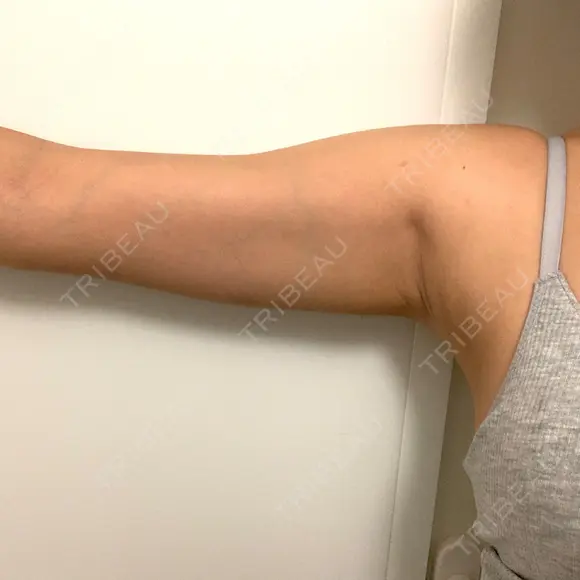 脂肪吸引（二の腕） ドクターフィット（Dr.fit）クリニック BEFORE メイン用