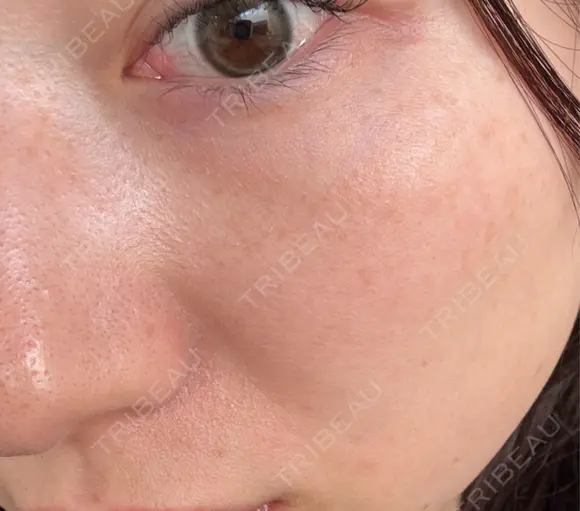 ピーリング（ハリ・ツヤ） / ルメッカ L‘amour clinic Tokyo【ラムールクリニック東京】 BEFORE メイン用