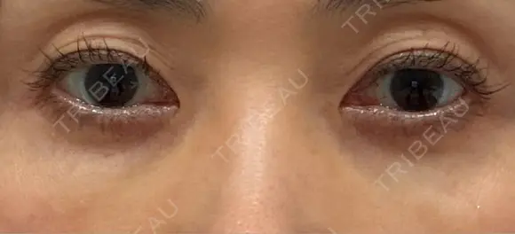 スネコス 札幌美容外科ネビュラクリニック BEFORE メイン用