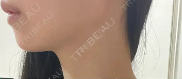 その他（輪郭） 美容皮膚科エルムクリニック 大阪院 BEFORE メイン用