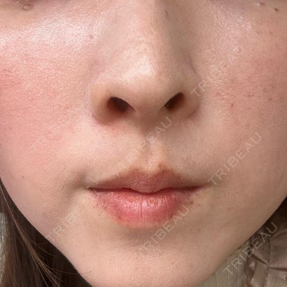 光治療（フォトフェイシャルなど） BITO BEAUTY CLINIC BEFORE メイン用