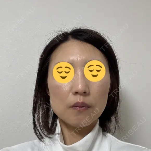 ボトックス（エラ・小顔） TCB東京中央美容外科 神戸院 BEFORE メイン用