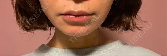 ボトックス（エラ・小顔） ルラ美容クリニック 郡山院 BEFORE メイン用