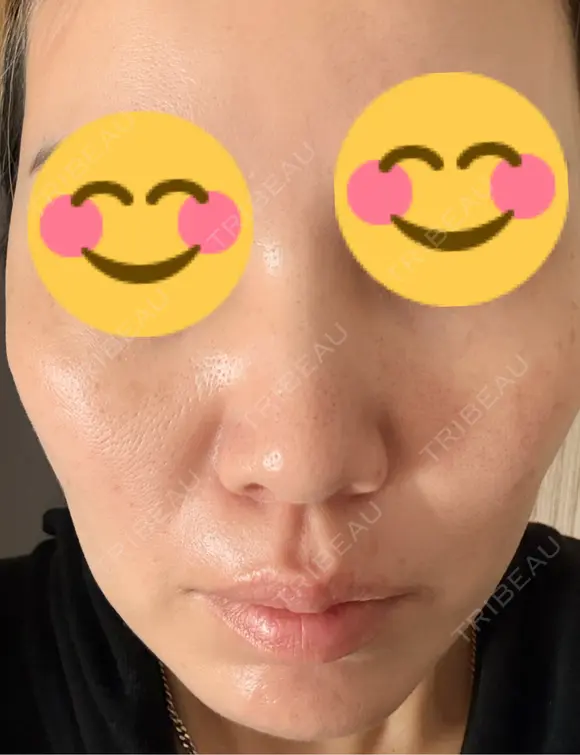 肌育注射（ジュベルックなど） 城本クリニック 豊橋院 BEFORE メイン用