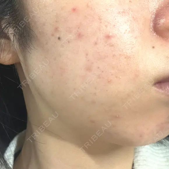 毛穴洗浄（ハイドラフェイシャルなど） / ルメッカ おおかみ美容のクリニック 新宿院 BEFORE メイン用