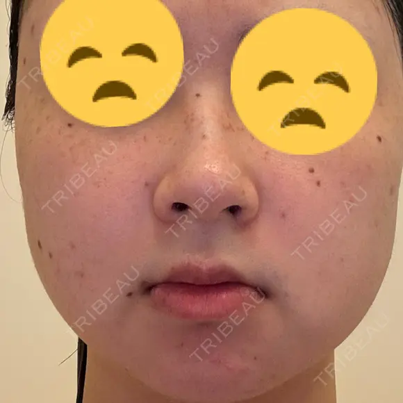 ほくろ・いぼ除去レーザー（肌） Fellez Clinic【フェルズクリニック】 BEFORE メイン用