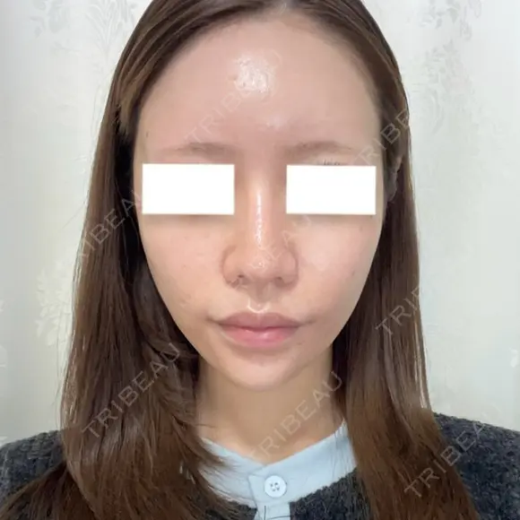 鼻尖形成（切開） / 軟骨移植 / 鼻修正 / 鼻孔縁挙上 / その他（鼻） WOM CLINIC GINZA （ワム クリニック ギンザ） BEFORE メイン用