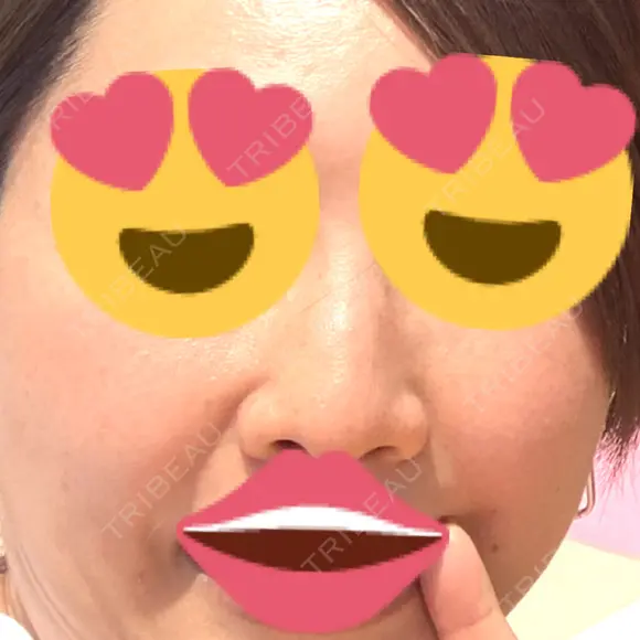 ピコスポット Fellez Clinic【フェルズクリニック】 BEFORE メイン用