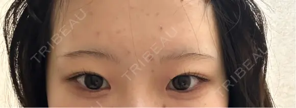 アートメイク（眉） G MEDICAL ART クリニック 新宿院 BEFORE メイン用