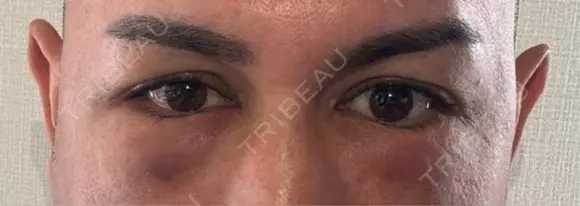 クマ治療 湘南美容クリニック 千葉センシティ院 BEFORE メイン用