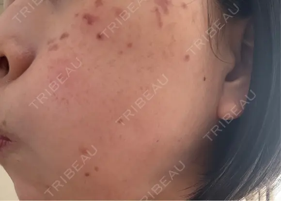 シミ取りレーザー / ピコレーザートーニング（美白・肝斑） 東京シルククリニック 東京神田院 BEFORE メイン用