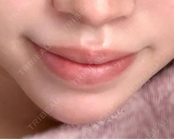 口唇縮小術 Stand by Beauty Clinic BEFORE メイン用