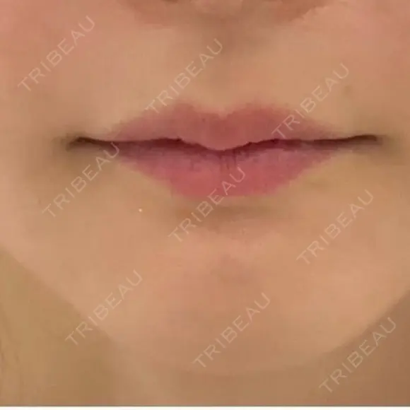 ヒアルロン酸注入（唇） / ヒアルロン酸注入（鼻翼基部） Moon Beauty Clinic BEFORE メイン用