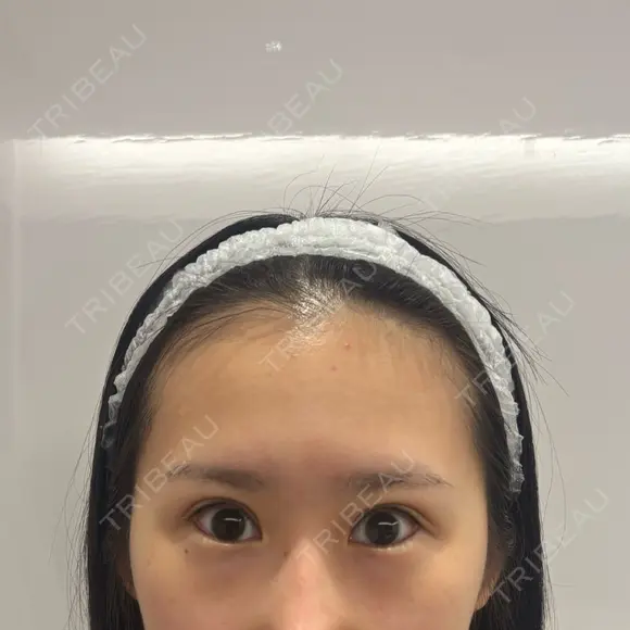 目尻切開 / タレ目形成・グラマラスライン（切開） BIANCA銀座 BEFORE メイン用