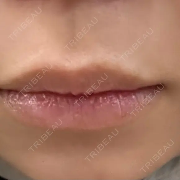 アートメイク（唇） TRUE DESIGN CLINIC BEFORE メイン用
