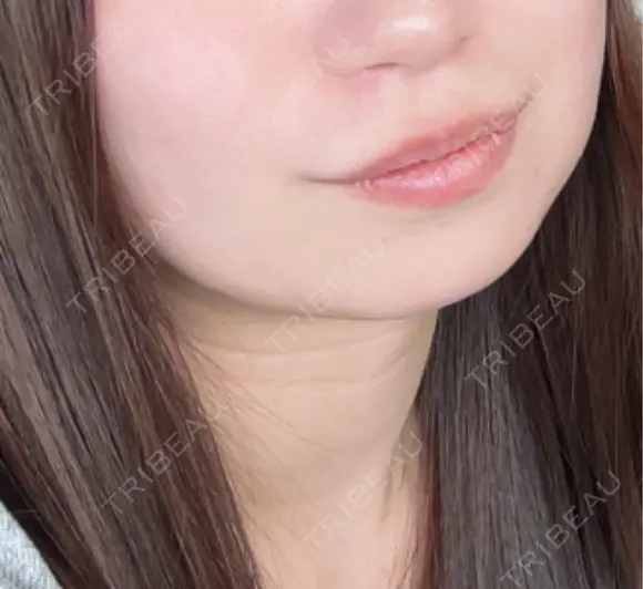 医療痩身（顔） / その他（肌） / RF（高周波）たるみ治療 / オンダリフト / その他（輪郭） ライブリークリニック 船橋院 BEFORE メイン用