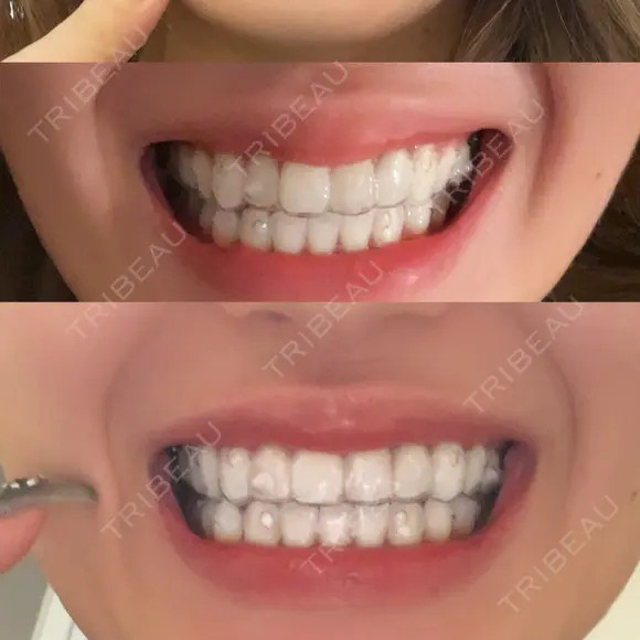 矯正（マウスピース） 銀座青山You矯正歯科 池袋西口医院 BEFORE メイン用