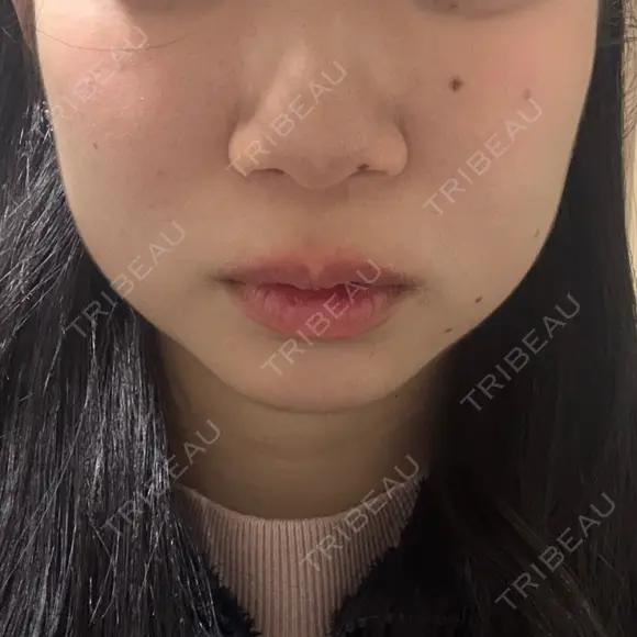 オンダリフト ルラ美容クリニック 渋谷本院 BEFORE メイン用