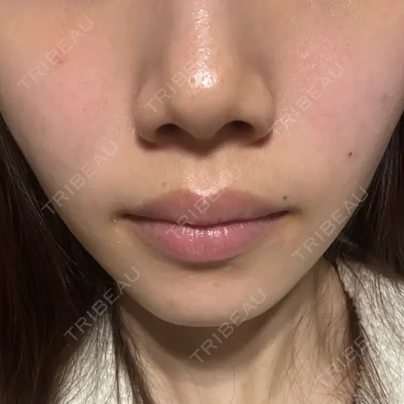 ボトックス（エラ・小顔） 新未来クリニック BEFORE メイン用