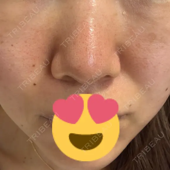 ニードルRF（ポテンツァなど） レナータクリニック 立川院 BEFORE メイン用