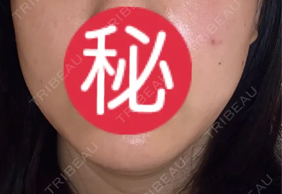 オンダリフト LIGHT CLINIC 【ライトクリニック】 名古屋院 BEFORE メイン用