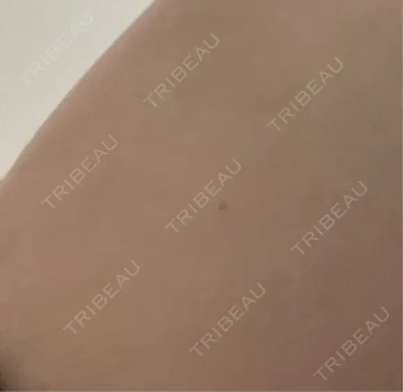 プラセンタ注射 吉祥寺アイビークリニック BEFORE メイン用